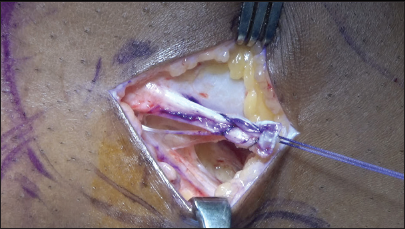 From the lateral view on the left knee, harvest of the lateral extra-articular tenodesis graft from the iliotibial band is performed on the operative leg (left knee)