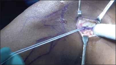 From the lateral view on the left knee, image shows post-anterior cruciate ligament reconstruction with lateral extra-articular tenodesis.