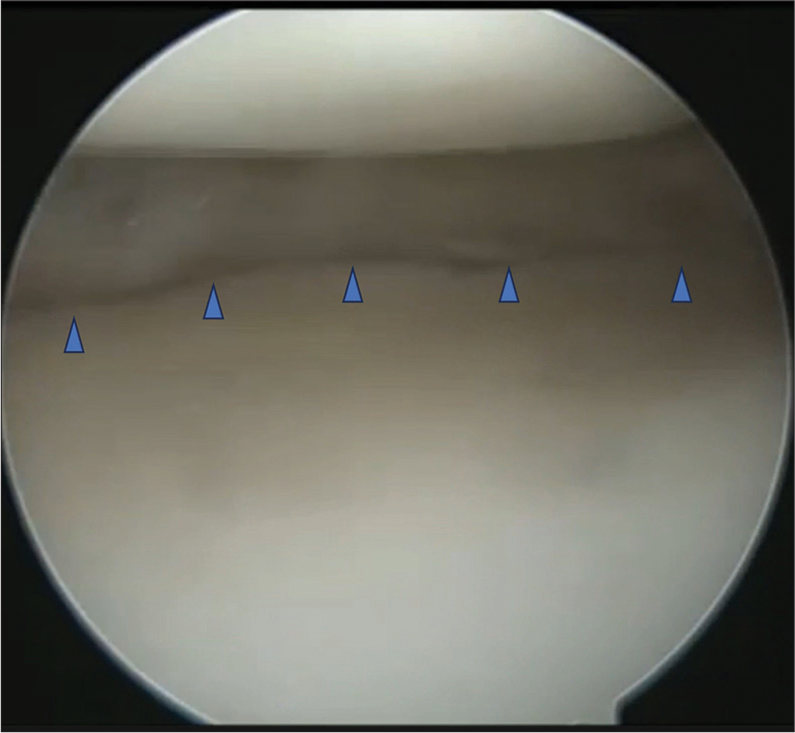 Near-total absence of meniscus tissue and absent roots due to auto-meniscectomy noted during arthroscopy (arrow heads).