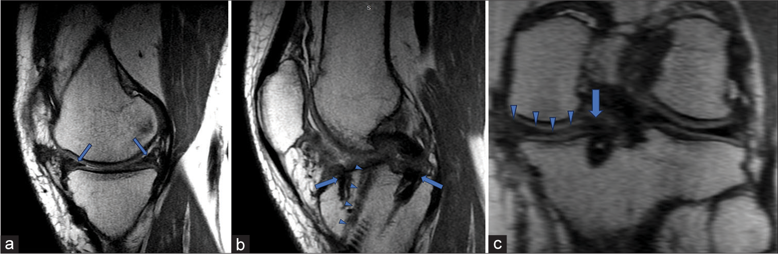 Selected sections of magnetic resonance imaging done at 6 months follow-up. (a) Sagittal section through the middle of the medial tibial plateau showing the wedge-shaped graft with hypointense signals (arrows). (b) Sagittal section passing through the roots of the medial meniscus graft (arrows). The edge of the anterior cruciate ligament graft in the tibial tunnel is also visualized (arrow heads). (c) Coronal section passing through the posterior horn (arrow heads) and posterior root of the meniscus graft (arrow).