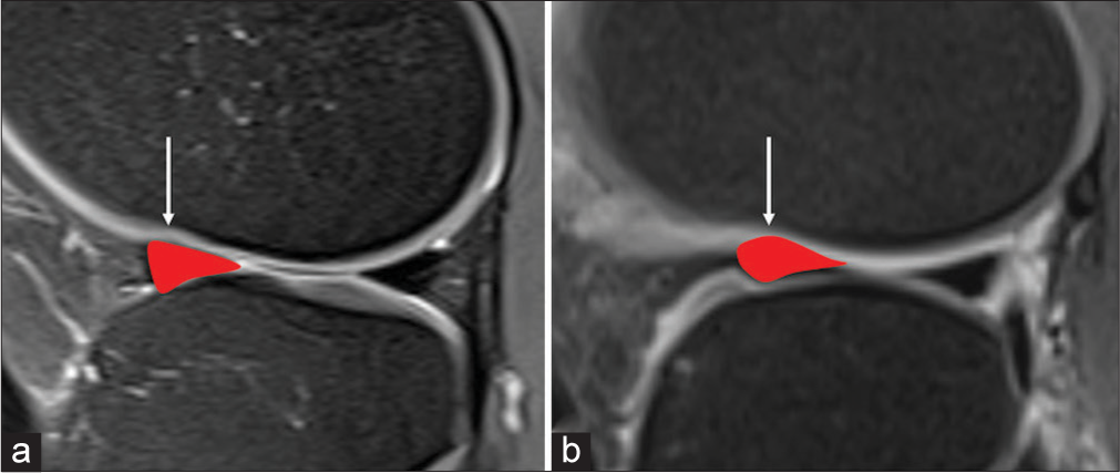 Sagittal proton density-weighted fat-suppressed image of the knee highlighting (a) normal morphology of anterior (arrow) horn of lateral meniscus and (b) “fish head” sign of anterior horn of lateral meniscus with schematic overlay (arrow).