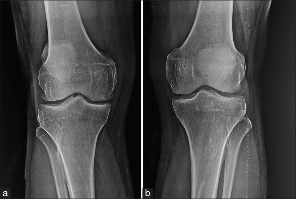 Plain radiograph of a 58-year-old male at his final 10-year follow-up after arthroscopic partial meniscectomy, showing well preserved joint space as compared to the non-operated knee (a) Operated knee, (b) Non-operated knee).