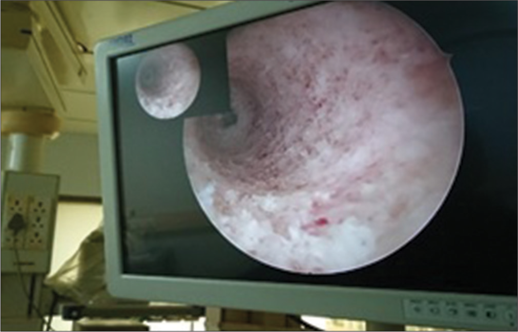 Anteromedial portal view of femoral tunnel.