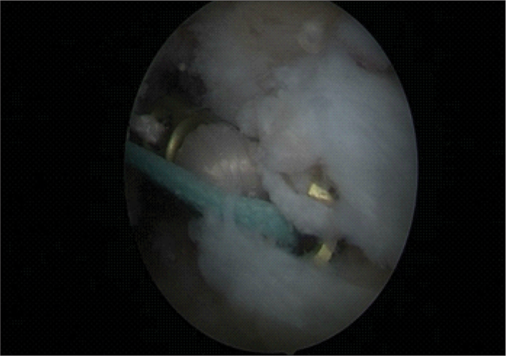 Scope view of endobutton passage.