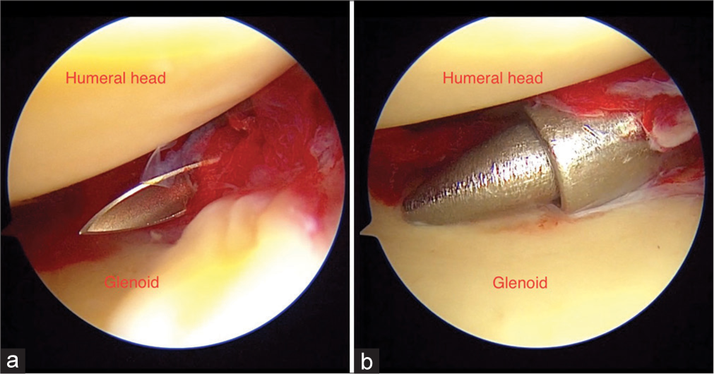 Left shoulder: (a and b) Showing working portal creation and gradual dilation.