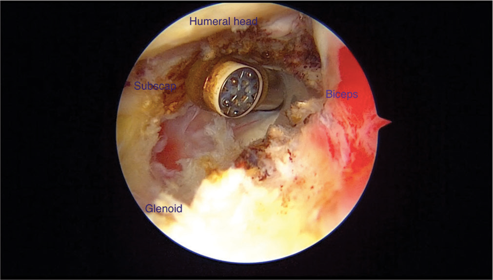 Left shoulder: Rotator interval release.