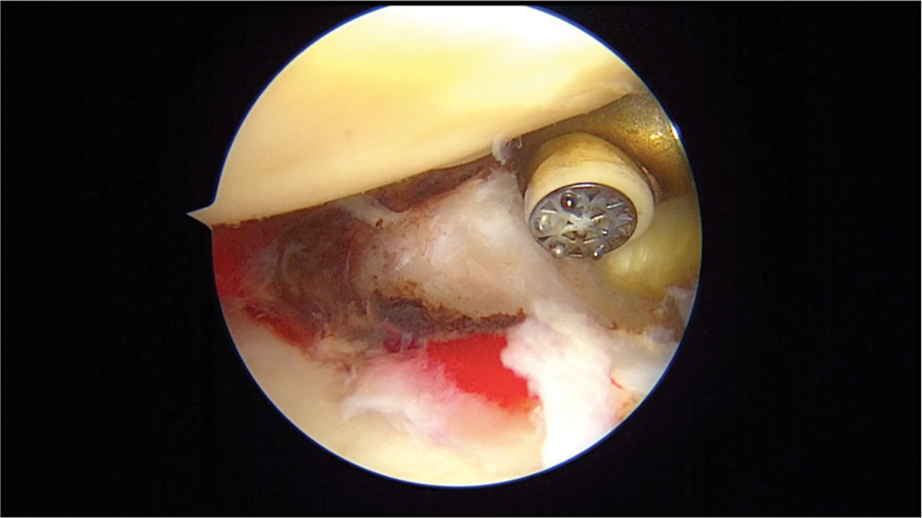 Left shoulder: middle glenohumeral ligament release.