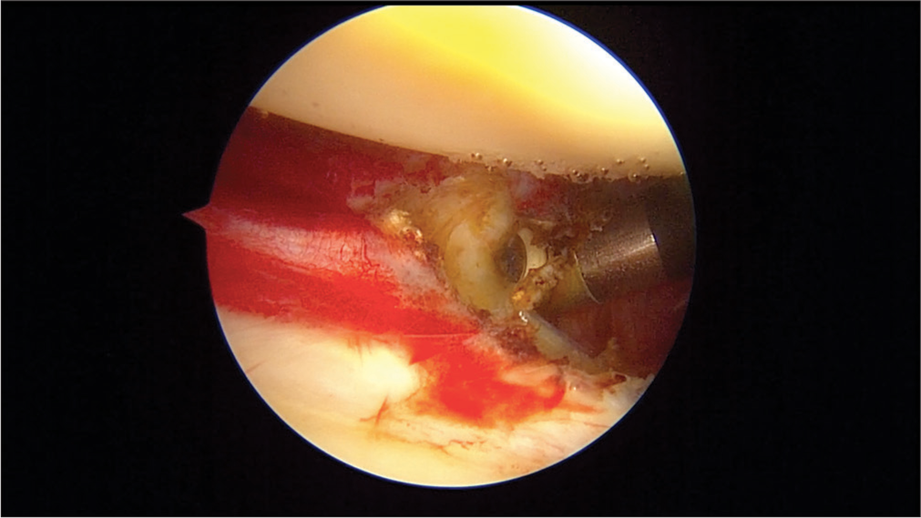 Left shoulder: Anterior capsule release.