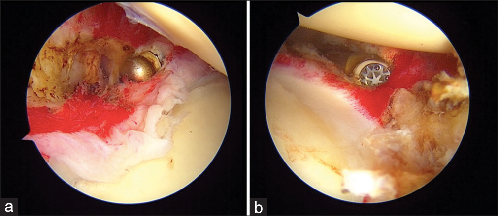 (a) Left shoulder: Posterior capsule release. (b) Left shoulder: Posterior inferior capsule release.