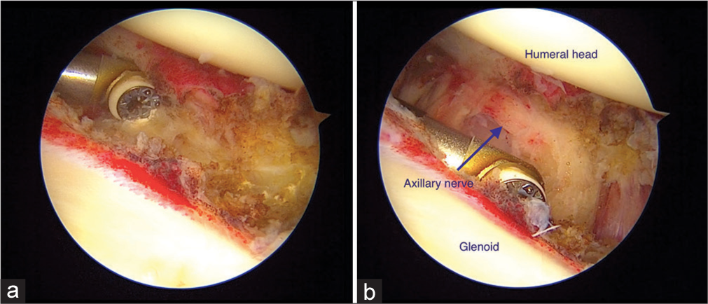 (a) Left shoulder: Inferior capsule release. (b) Left shoulder: Careful for axillary nerve during inferior capsular release.