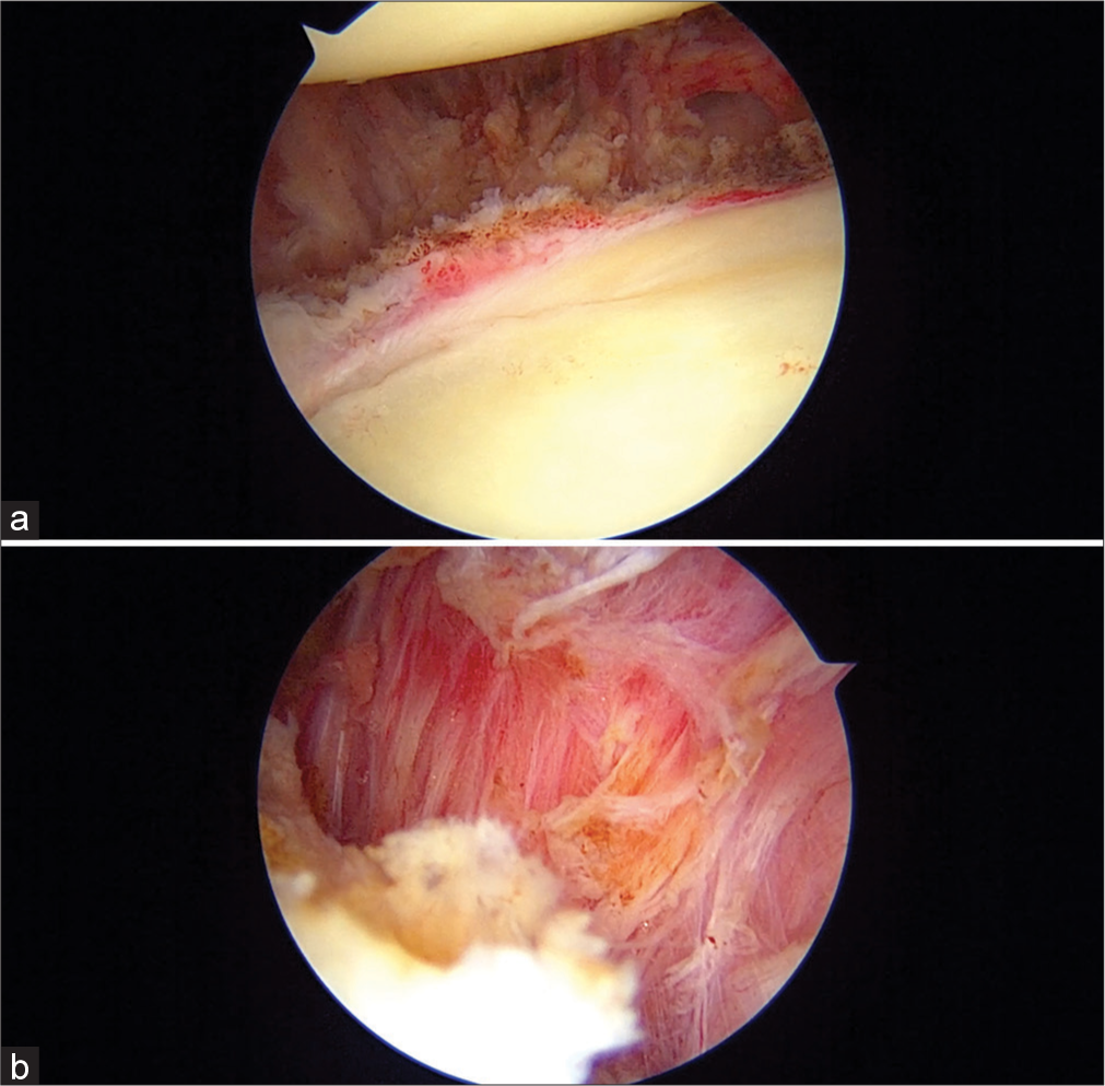 Left shoulder: (a and b) Showing adequacy of release by visualization of muscle tissue.