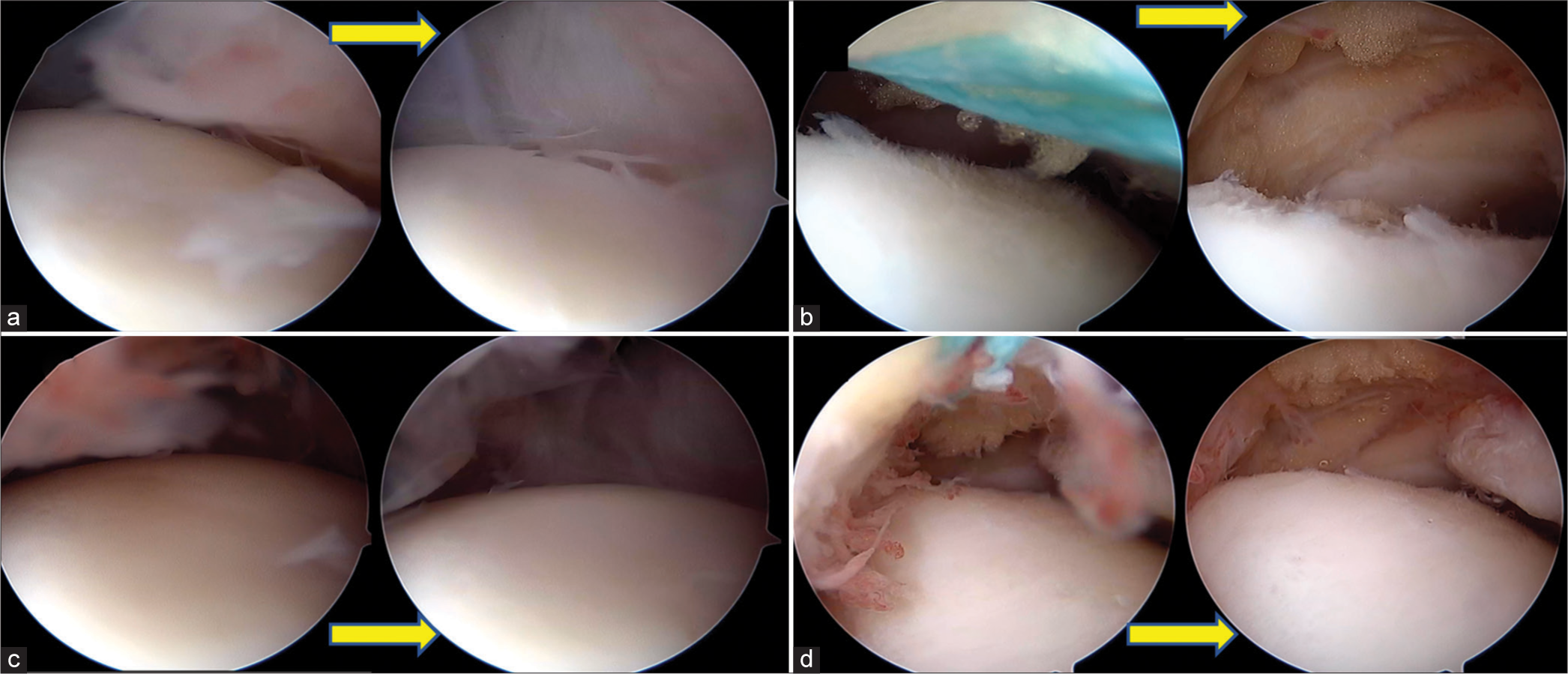 Each pair of images (a-d) with arrows depicting before and (arrow pointing to after traction image) after traction with the suture. It can be seen that the view of the anterior aspect of the ankle significantly improves after traction in each instance.