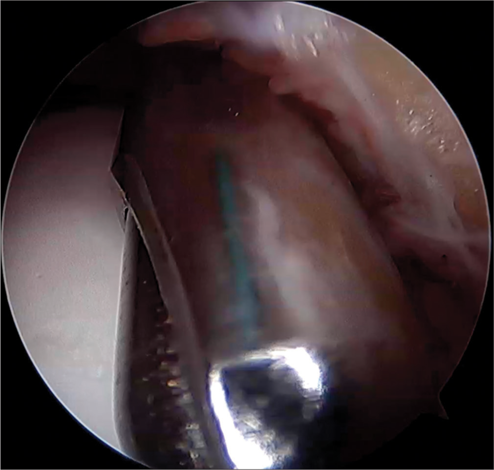 Reflection of the Ethibond suture seen on the shaver to avoid inadvertently cutting off and marking the position of the capsule.