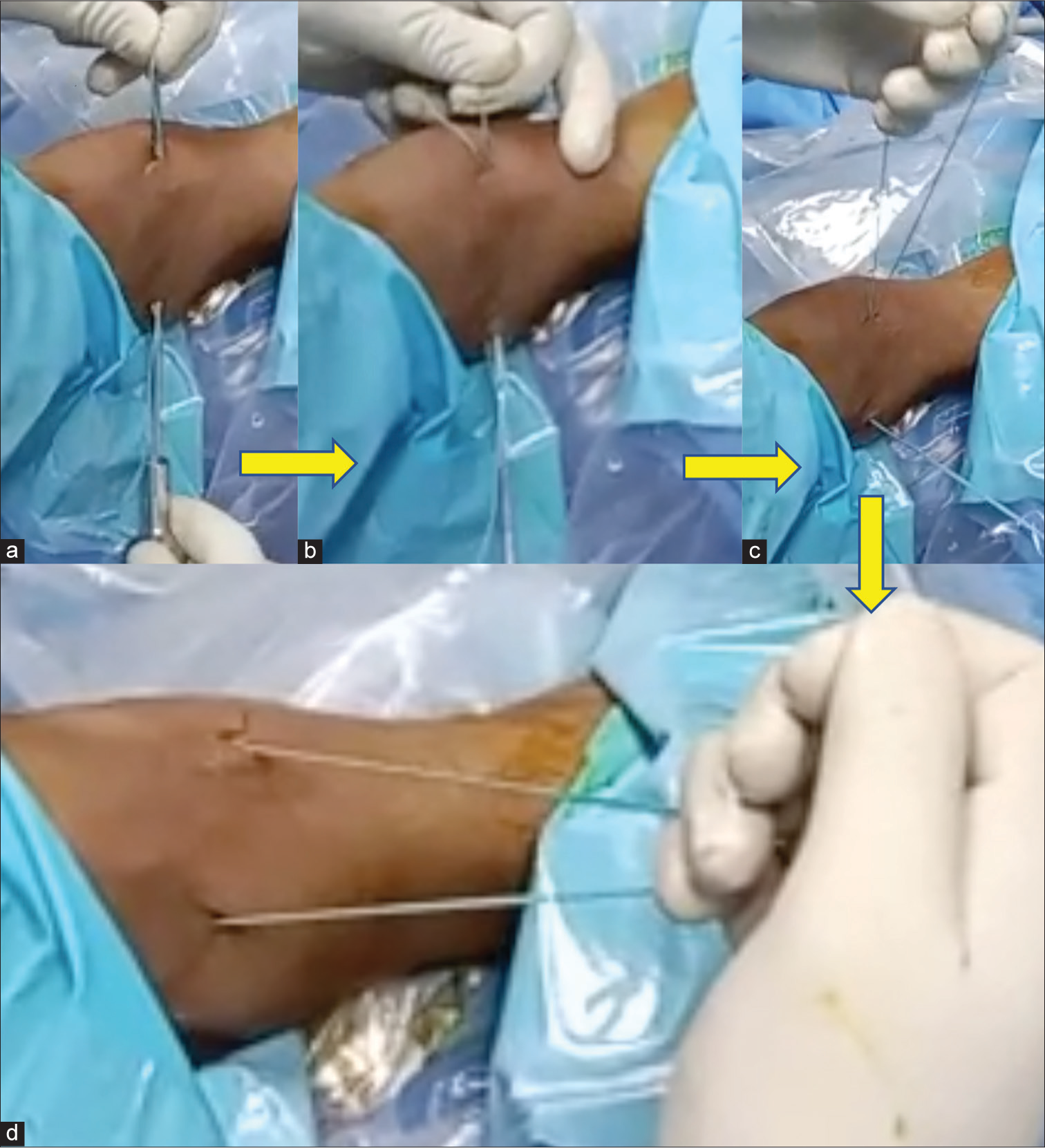 Steps in placing the retractor. (a) Suture coming out of both portals. (b) Retaining loop on one side pulling out knot pusher, (c) After removal of knot pusher, (d) Final position, ready for retraction. The yellow arrows indicate progression of steps in passing the traction suture.