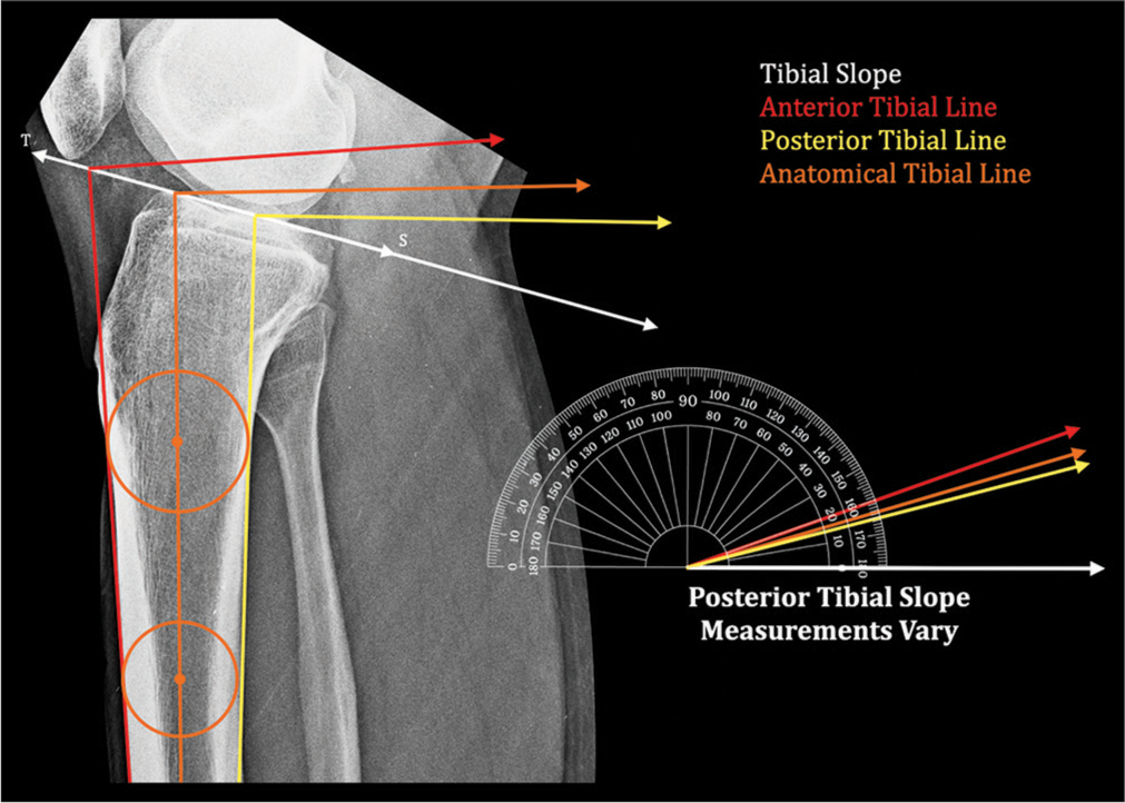 Posterior tibial slope measurements vary depending on the line of reference. Tibial slope (TS) line – Line joining the anterior and posterior edge of tibial plateau, : Anterior tibial line, : Posterior tibial line, : Anatomical axis. Circles are marked touching the anterior and posterior tibial cortex. Line joining their centers represents the Anatomical Axis of Tibia (AAT).