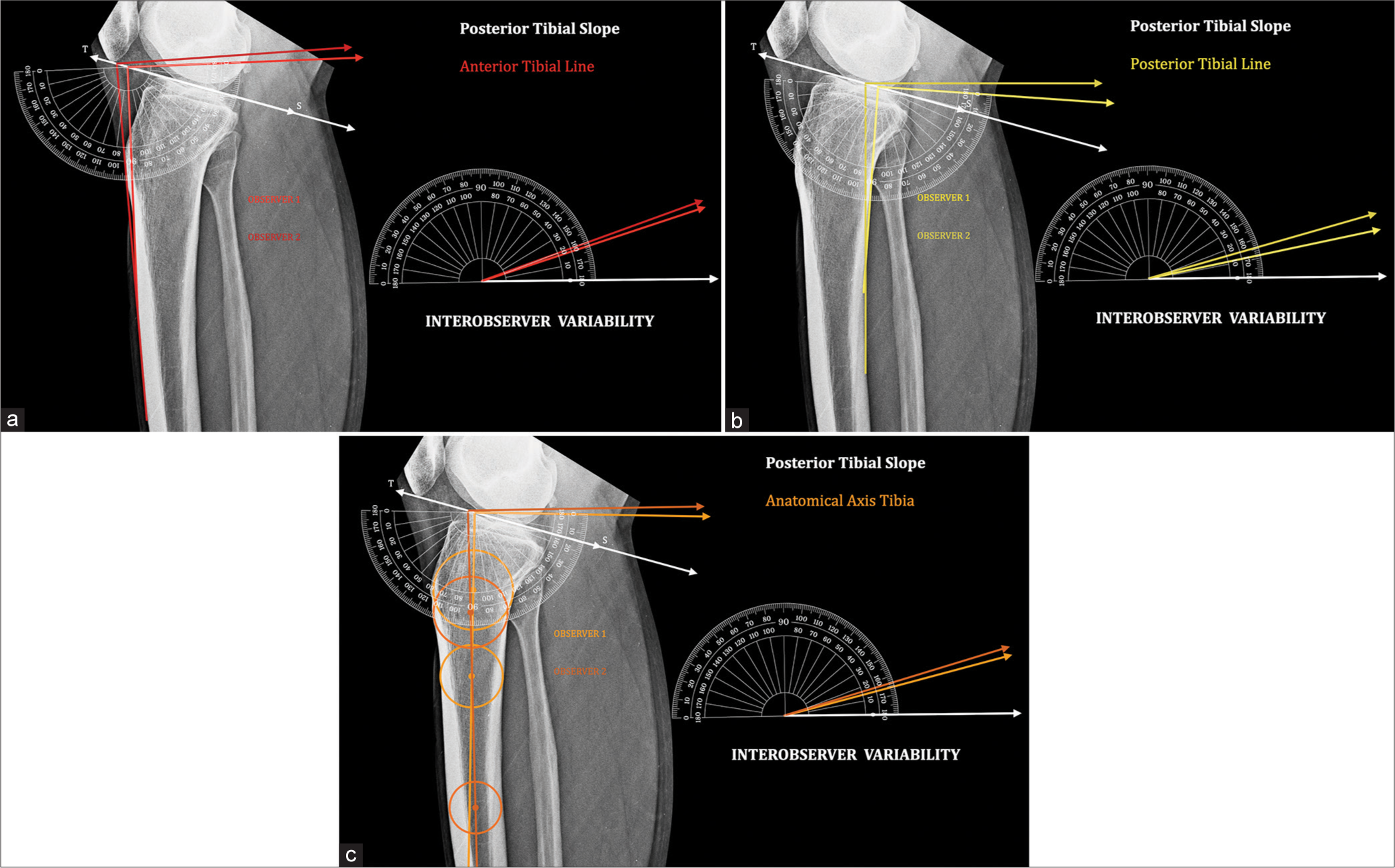 Interobserver variability: Tibial slope (TS) line – Line joining the anterior and posterior edge of tibial plateau. Posterior tibial slope measured by two observers shows a significant difference and therefore erroneous. (a) Anterior tibial line. : Observer 1, : Observer 2. (b) Posterior tibial line. : Observer 1, : Observer 2. (c) Anatomical axis tibia. : Observer 1, : Observer 2.