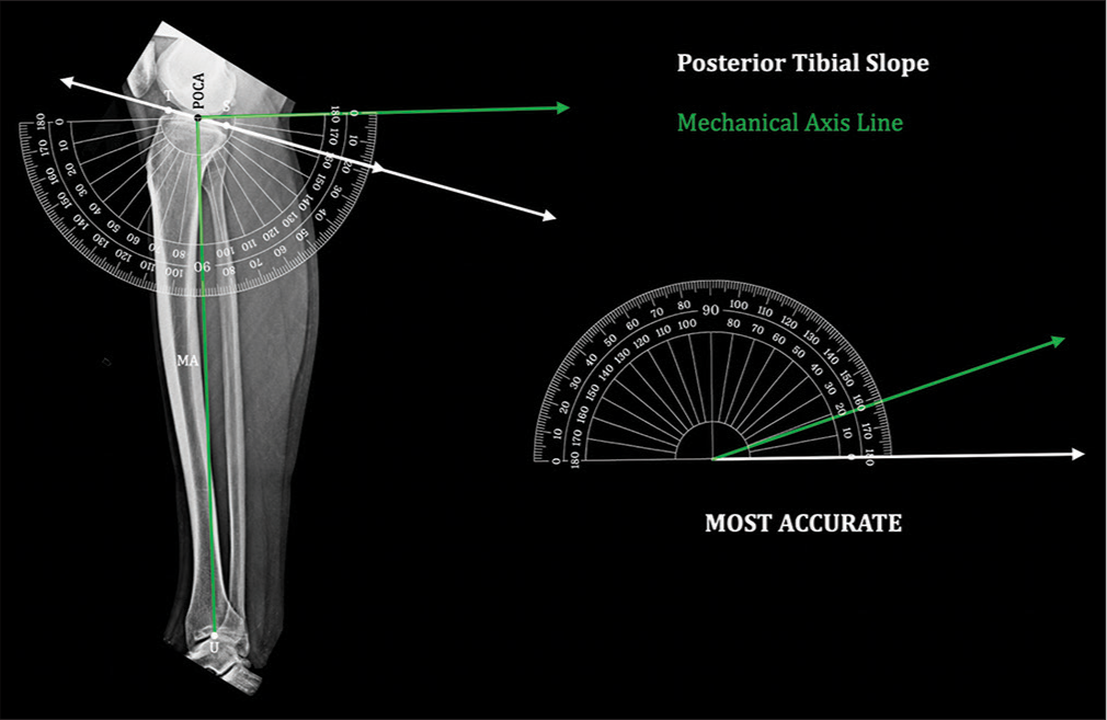 Posterior tibial slope by “mechanical axis”: Posterior tibial slope measured by this method has standard points of measurement without errors. It is therefore the most accurate method. Tibial slope (TS) line – Line joining the anterior and posterior edge of tibial plateau, Point of calculation of angle (midpoint of the segment TS¯ ) – POCA, midpoint of tibial plafond at ankle – U, mechanical axis (POCA U¯) – MA.