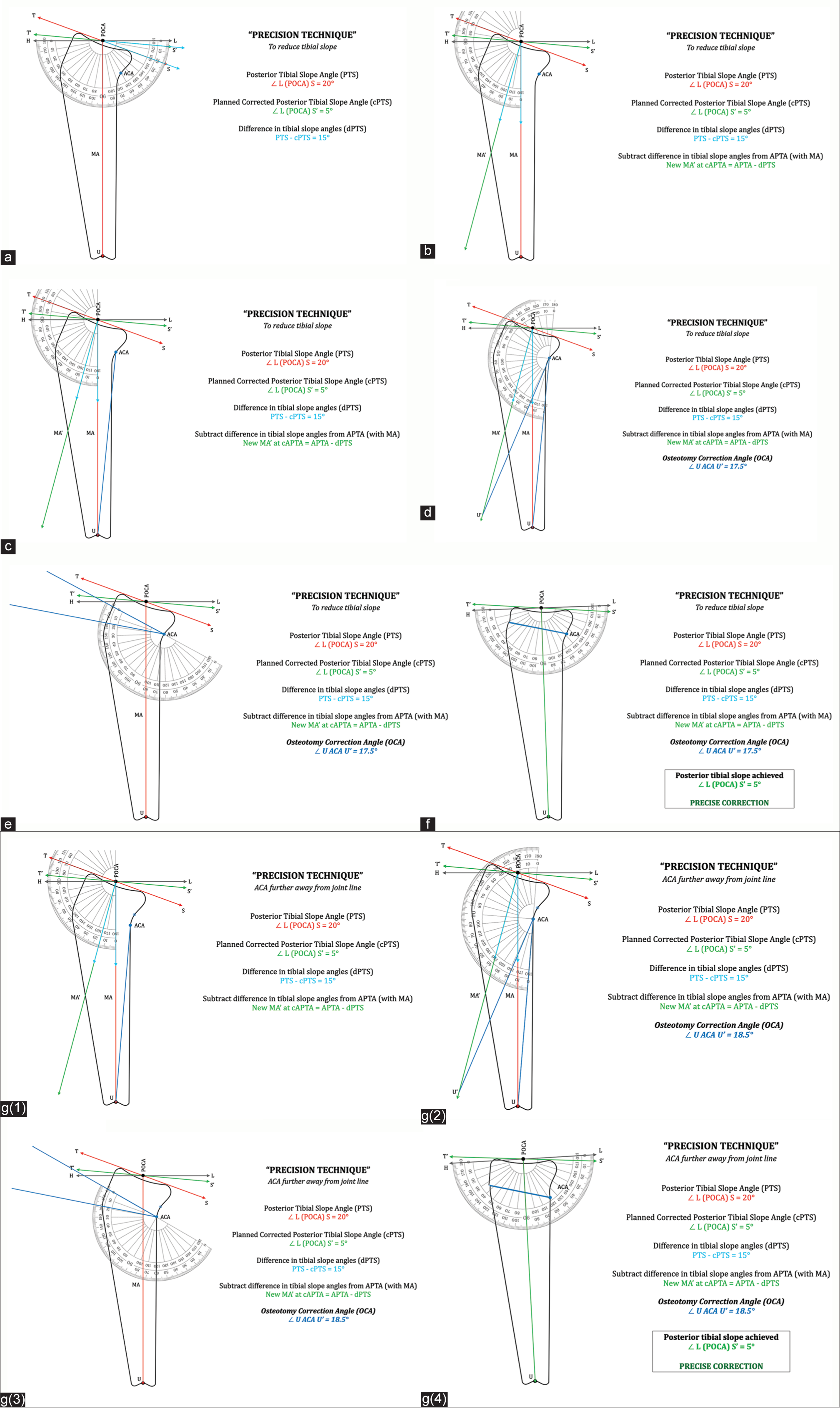 “Precision technique” of calculating posterior tibial slope correction: Tibial slope line/segment – TS, Planned postoperative tibial slope – T’S’, Point of calculation of angle (midpoint of tibial plateau) – POCA, Midpoint of tibial plafond at ankle – U, Pre-operative mechanical axis ( POCA U¯ ) – MA, Planned post-operative mechanical axis – MA’ , Pre-operative posterior tibial slope angle – PTS, Postoperative planned (corrected) posterior tibial slope angle – cPTS, Anterior proximal tibial angle ∠ T (POCA) U – APTA, Planned corrected anterior proximal tibial angle – cAPTA, Axis of correction of angulation – ACA, Osteotomy correction angle – OCA. (a) Difference in posterior tibial slope angles (dPTS). dPTS = PTS – cPTS = ∡ S (POCA) S.’ (b) To reduce tibial slope angle: New mechanical axis MA’ with new anterior proximal tibial angle (cAPTA) is marked at POCA by subtracting dPTS from anterior proximal tibial angle (APTA). MA’ at ∡ cAPTA = APTA – dPTS. (c) Draw a line segment from ACA to U. (d) Extend an arc of radius ACA U¯ onto the new mechanical axis MA’ to intersect at point U’. This measure of angle ∡ U ACA U’ is the final precise OCA. (e) OCA is marked at the axis of correction of angulation (ACA) replicating the osteotomy wedge. (f) OCA wedge is closed. Posterior tibial slope angle is measured ∠ L (POCA) S. Posterior tibial slope achieved is precisely same as the planned corrected posterior slope (cPTS) of 5°. (g) ACA further away from joint line: g(1) Draw a line segment from ACA to U. g(2) Extend an arc of radius ACA U¯ onto the new mechanical axis MA’ to intersect at point U’. This measure of angle ∡ U ACA U’ is the final precise OCA. Note that the measure of OCA changes as the position of ACA changes. g(3) OCA is marked at axis of correction of angulation (ACA) replicating the osteotomy wedge. g(4) OCA wedge is closed. Posterior tibial slope angle is measured ∠ L (POCA) S. Posterior tibial slope achieved is precisely same as the planned corrected posterior tibial slope (cPTS) of 5°.