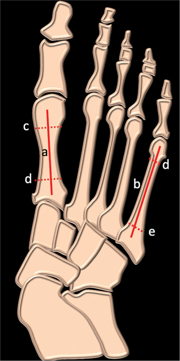 Schematic of dorsoplantar radiographs of foot showing angle between line a (along the shaft of first metatarsal) and line b (line along the shaft of fifth metatarsal), this is drawn by joining the midpoints of the proximal and distal shaft of metatarsal (dotted lines c, d, e)