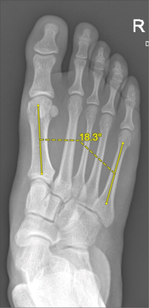 Dorsoplantar radiograph of the foot showing the angle between the lines (yellow) along the shaft of the first and fifth metatarsals.