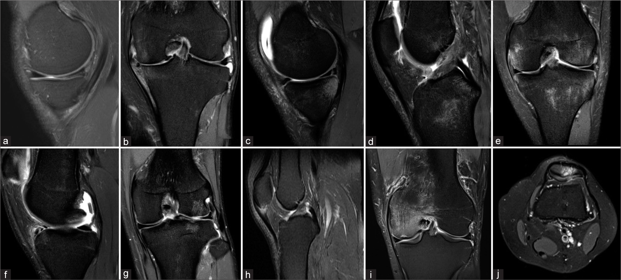 Key images that were uploaded on the ChatGPT4V model. (a) A 30-year-old male with a medial meniscal tear, (b) a 40-year-old male with severe medial tibiofemoral degenerative change and complex medial meniscal tear, (c) meniscal tear (RAMP lesion) in a 33-year-old male with osseous edema of the posterior part of the medial tibial plateau, (d) a 20-year-old female with an anterior cruciate ligament tear, (e) a 30-year-old male with grade 2 sprain of the meniscofemoral ligament with mild osseous edema of the medial femoral condyle, (f) a 40-year-old male with 10 mm chondral loose body in the posterior recess, (g) a 28-year-old male with a 10 mm chondral defect of lateral femoral condyle with subchondral osseous edema, (h) a 30-year-old male with patellar tendinopathy at the level of the lower pole of patella, (i) a 60-year-old male with subchondral insufficiency fracture of medial femoral condyle with osseous edema, and (j) a 60-year-old male with mild patellofemoral arthritis.