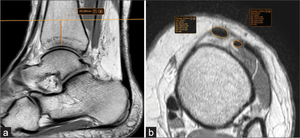 (a) Proton-density (PD) sagittal image shows the reference point for measurements, 2 cm cranial to the ankle joint. (b) Cross-sectional area measurements, taken by manual tracing technique on PD axial age.