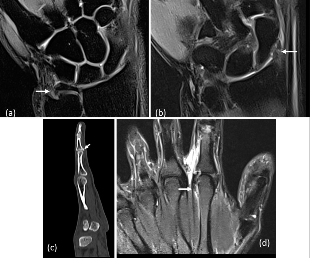 Hand and wrist injuries in cricket. (a and b) Batsman with fall on outstretched hand while running between the wickets. Coronal proton density (PD) fat sat images show a complete tear of dorsal and volar radio-ulnar ligaments (a) and a complete tear of the radial collateral ligament (b) with mild edema in the adjacent radial styloid process (arrows). (c) The fielder with a hyperextension injury to the third finger while trying to catch the ball. The sagittal computed tomography image shows an avulsion fracture at the base of the middle phalanx with a fracture line extending into the proximal inter-phalangeal joint. This represents a volar plate avulsion fracture. (d) Off-spin bowler with long-standing pain in the second metacarpo-phalangeal joint. Coronal PD fat sat magnetic resonance imaging images show a partial tear of the ulnar collateral ligament of the second metacarpo-phalangeal joint, postulated to be a chronic overuse injury from spinning the ball (“Off-spinner’s finger”).