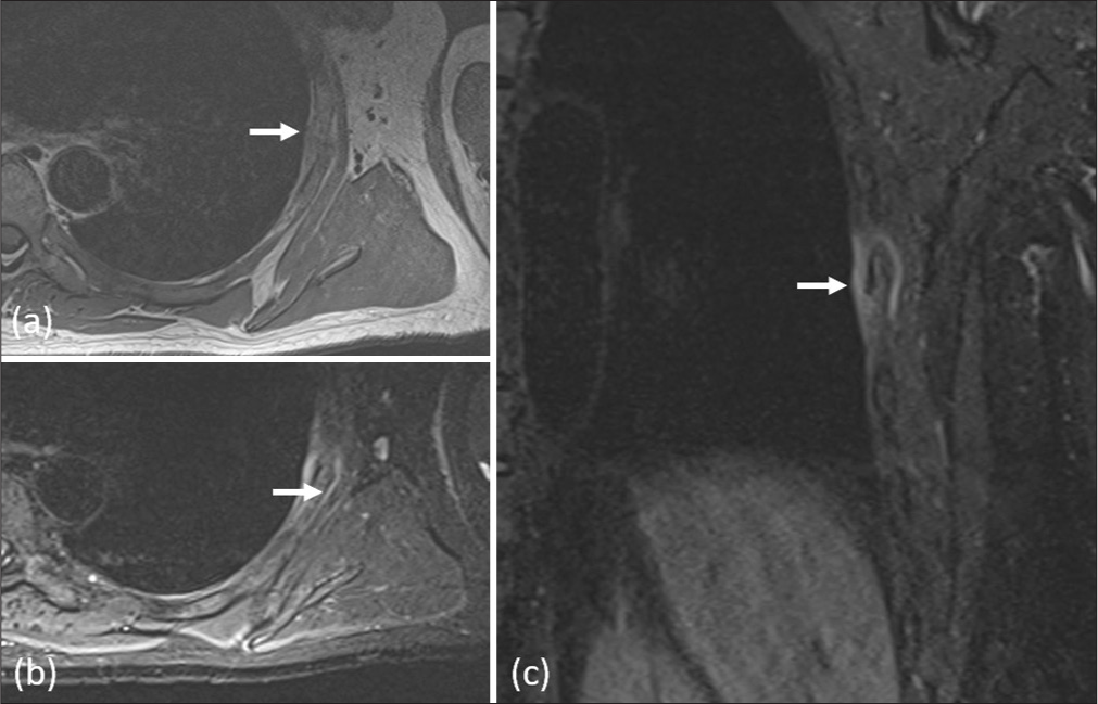 Cricketer with left thoracic wall pain following impact from a ball while batting (such a ball being colloquially called a “rib tickler”). (a) Axial T1 image shows hypointensity in the left rib marrow. (b) and (c) Axial and coronal short-tau inversion recovery images show marrow edema in the rib with adjacent soft-tissue edema. The athlete had a linear, minimally displaced rib fracture.