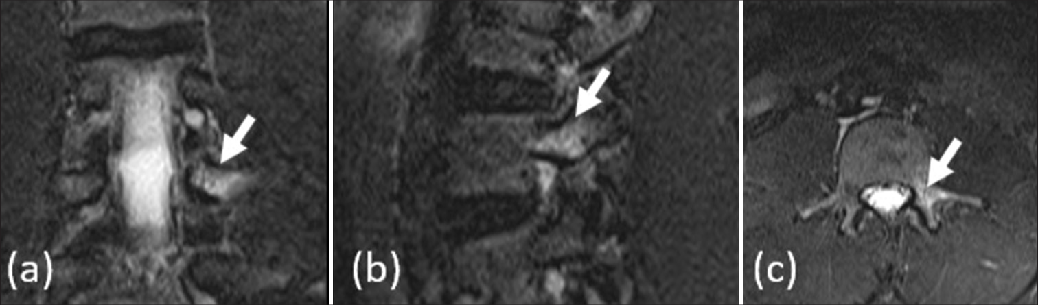 Fast bowler with low back pain. (a) coronal, (b) sagittal, and (c) axial magnetic resonance imaging short-tau inversion recovery images demonstrate edema in the left pars interarticularis of L3 vertebra (white arrows), without cortical breach. This indicates a stress reaction of the pars interarticularis.