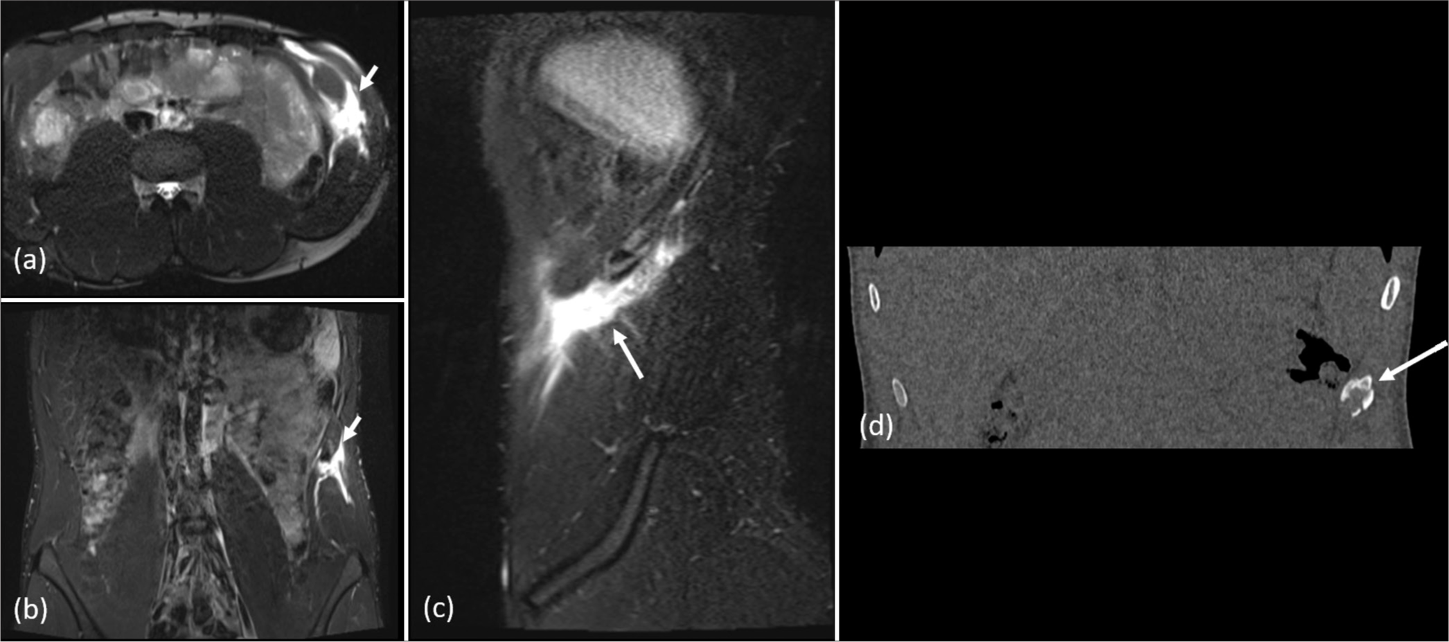 Fast bowler with acute onset pain in the left lateral aspect of the abdomen. (a) axial, (b) coronal, and (c) sagittal magnetic resonance imaging short-tau inversion recovery images demonstrate a complete tear of the left internal oblique muscle near its origin from the lower ribs (white arrows). (d) Coronal computed tomography image shows an avulsion fracture of the left 11th rib at the site of attachment of internal oblique muscle (arrow).