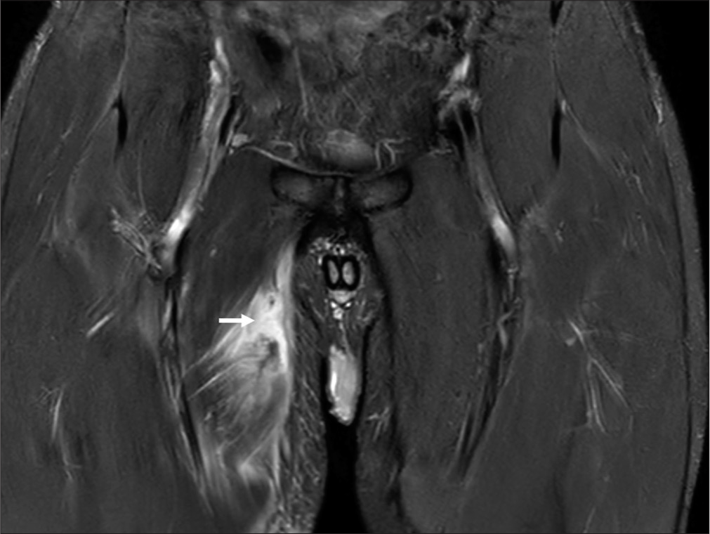 Cricketer with right groin pain. Magnetic resonance imaging short-tau inversion recovery coronal image shows a complete tear of the right adductor longus muscle 4 cm below its origin, with complete separation of fibers and fluid signal intensity/hematoma (white arrow). There is edema in the adjacent muscle fibers.