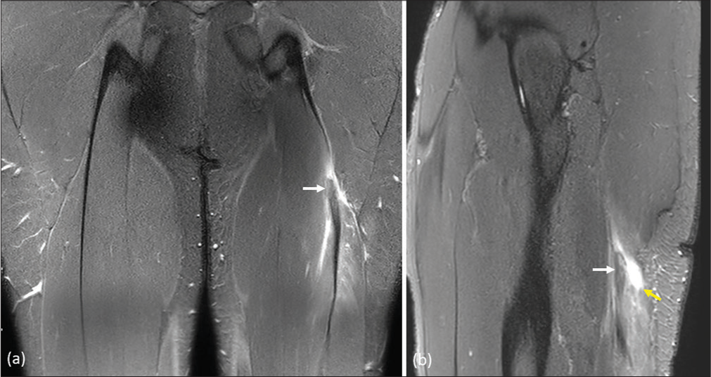 Magnetic resonance imaging short-tau inversion recovery (a) coronal and (b) sagittal images respectively, in a cricketer with posterior thigh pain. These show edema with fluid signal intensity (yellow arrow) in the biceps femoris muscle with thickening and hyperintensity within its tendon (white arrow). British athletics muscle injury classification grade 2c injury.