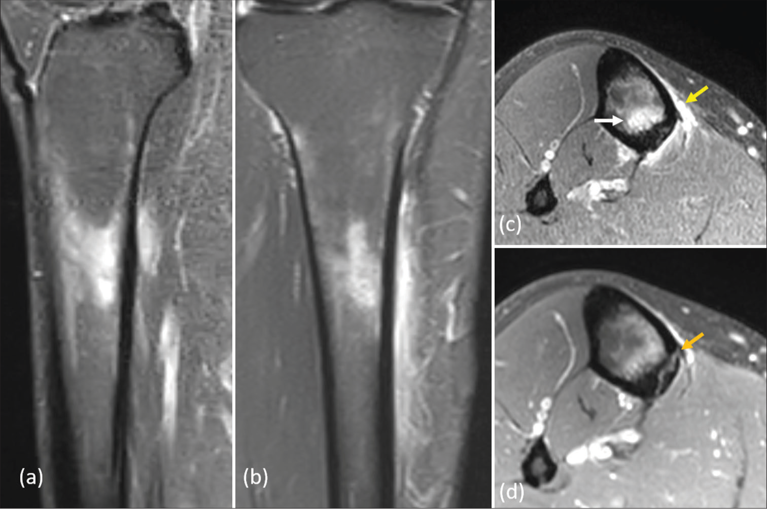 Magnetic resonance imaging short-tau inversion recovery (a) sagittal, (b) coronal, (c) and (d) axial images respectively, in a cricketer with pain in the right anteromedial leg. Marrow edema (white arrow) and subperiosteal edema (yellow arrow) in tibia with cortical linear hyperintensity (orange arrow). Fredericson grade 4b tibial stress injury (in this case a stress fracture).