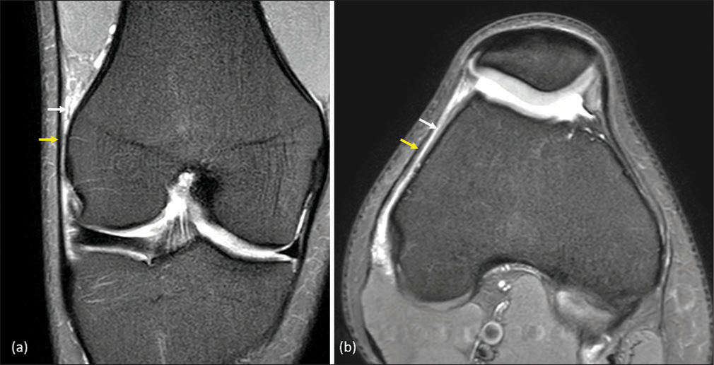 Cricketer with pain along the lateral aspect of the knee. Magnetic resonance imaging proton density fat sat (a) coronal and (b) axial images show edema (white arrow) in the soft tissues deep to the iliotibial band (yellow arrow). These findings indicate iliotibial band friction syndrome.