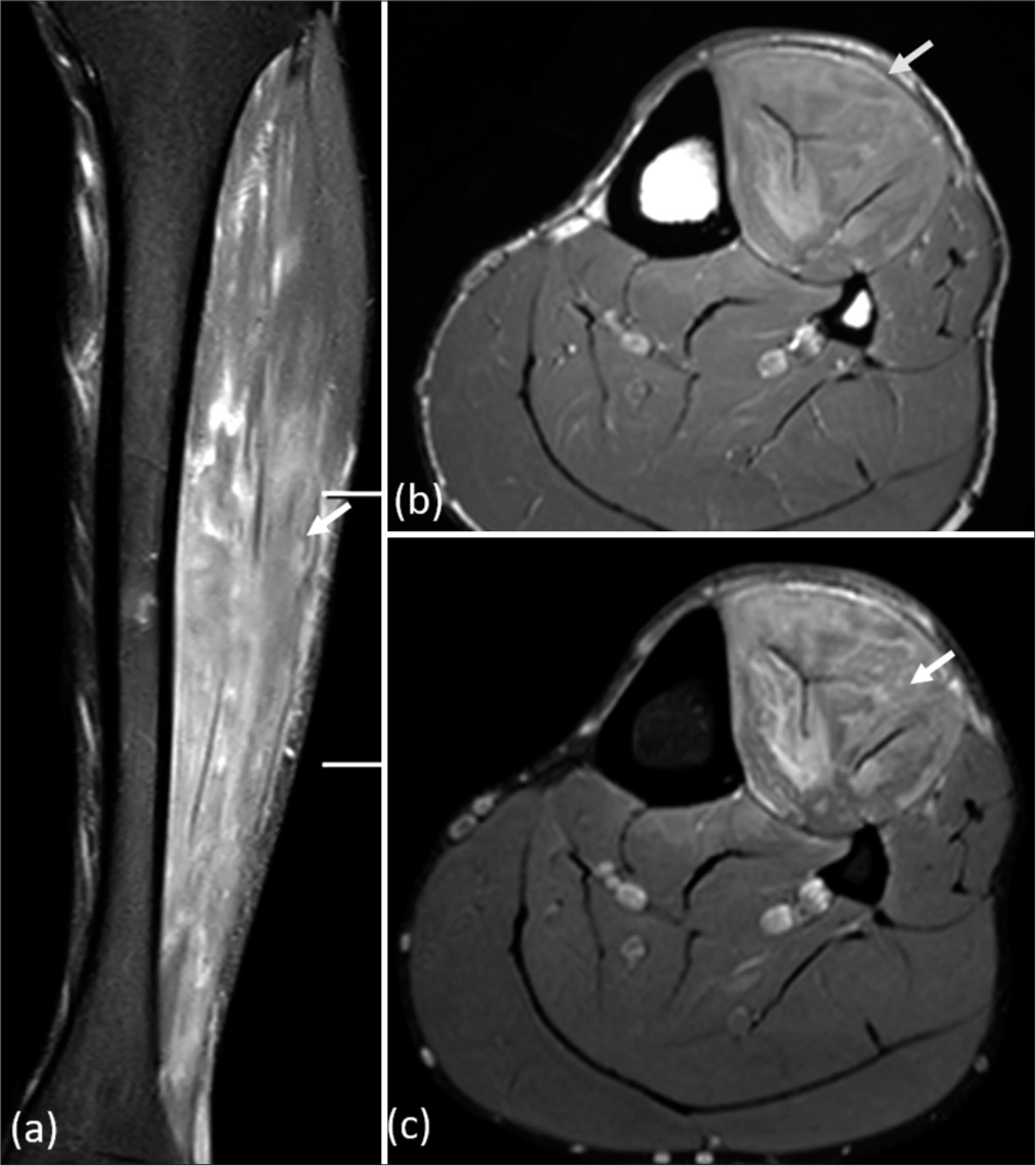 Magnetic resonance imaging short-tau inversion recovery (STIR) (a) coronal, (b) axial T1, and (c) axial STIR images respectively, show anterior bowing of the anterior compartment fascia (yellow arrow), with significant edema within the anterior compartment muscles (white arrow). These findings indicate acute compartment syndrome.