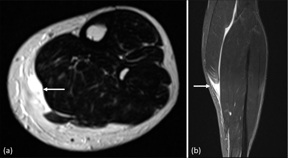 Batsman with a calf injury while running between the wickets. Axial T2 (a) and coronal short-tau inversion recovery (b) magnetic resonance imaging images show a complete tear of medial gastrocnemius with retraction of fibers till mid-calf, also called “tennis leg.”