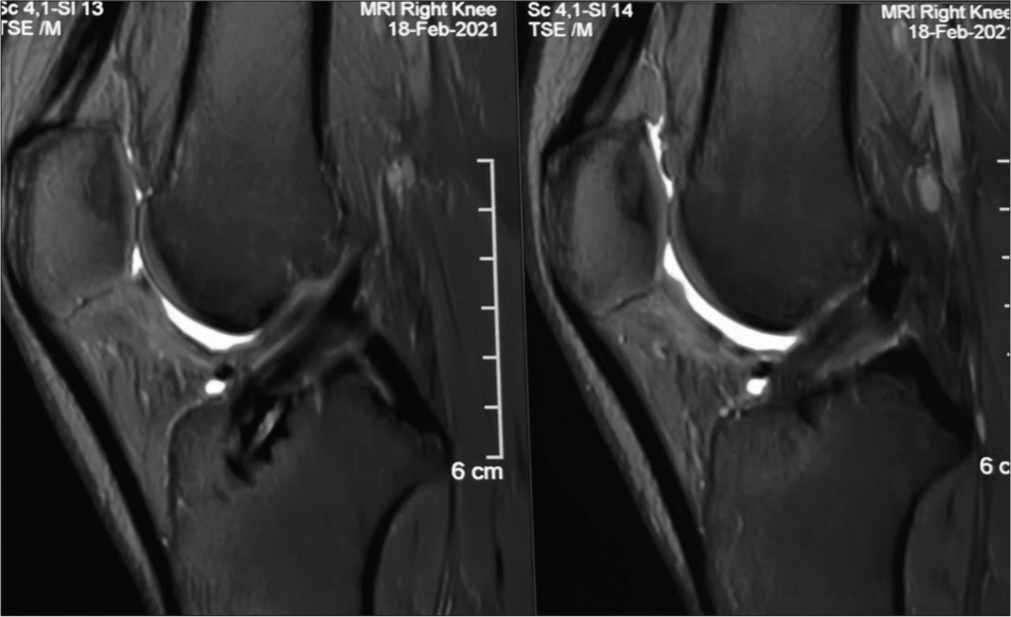 Magnetic resonance imaging RI T2 sagittal section showing graft looking similar to the native anterior cruciate ligament at one-year follow-up.