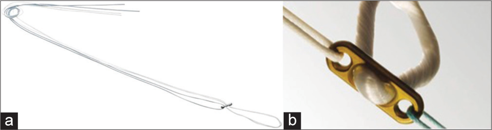 Extracortical suspensory fixation (a) adjustable loop (Arthrex-TightRope RT). (b) Fixed loop (Smith & Nephew EndoButton).