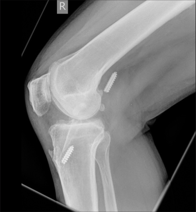 Migration of screws in the popliteal fossa (Case courtesy of Henry Knipe, Radiopaedia.org, rID: 72407).