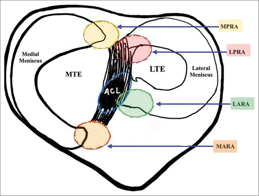 The top surface of the tibia depicting the attachment of the roots of the menisci. MPRA: Medial posterior root attachment, LPRA: Lateral posterior root attachment, LARA: Lateral anterior root attachment, MARA: Medial anterior root attachment, ACL: Anterior cruciate ligament, MTE: Medial tibial eminence, LTE: Lateral tibial eminence.