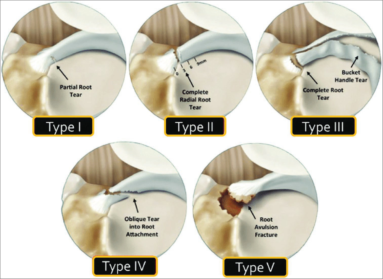 Classification of meniscal root tears (LaPrade’s system, 2014).