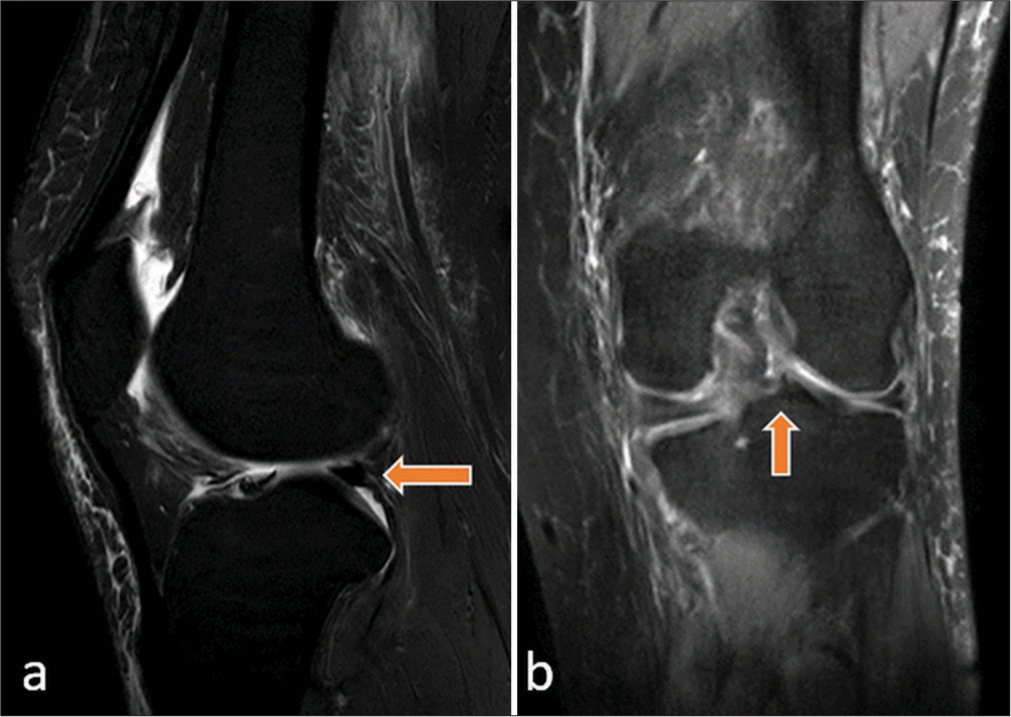 Fast spin echo T2-weighted fat suppression images (a) sagittal section shows the oblique tear of the posterior horn of the medial meniscus extending into the root attachment (left arrow) and (b) coronal image with a change in signal intensity (right arrow).