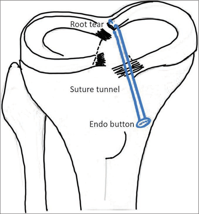 Transtibial pull-out repair of a medial meniscal posterior root tear in a right knee.