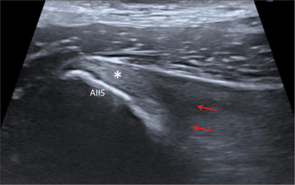 Normal longitudinal (sagittal) ultrasound image of the rectus femoris (RF) muscle. Longitudinal fibrillar pattern of the normal straight (direct) head (asterisk) origin at the anterior inferior iliac spine (AIIS). RF reflected (indirect) head (red arrows) is visualized as an area of acoustic shadowing due to changing caliber of fibers which attach to the superior acetabular ridge.