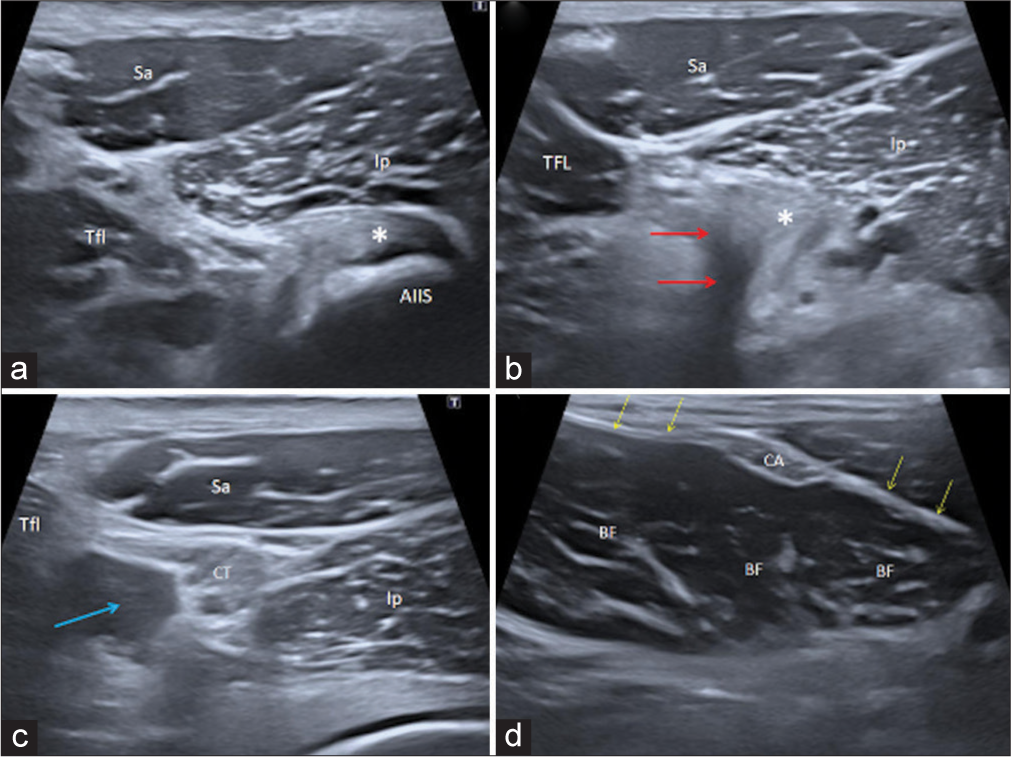 Sequential cranial to caudal transverse ultrasound images (left column) with corroborative axial MRI images (right column) of a normal right RF muscle and surrounding structures. (a) RF straight (direct) head origin (asterisk) at the AIIS. (b) RF reflected (indirect) head (red arrows) is visualized as an area of acoustic shadowing due to changing caliber of fibers which attach to the superior acetabular ridge; the corroborative MRI depicts this clearly. The straight (direct) head (asterisk) is seen adjacent to this. (c) Conjoint tendon of the RF at the myotendinous junction with the muscle belly forming at the lateral margin (blue arrow). (d) RF muscle belly. CA formed by the reflected (indirect) head and an indistinct anterior aponeurosis (yellow arrows) formed by the straight (direct) head. RF: Rectus femoris muscle belly, asterisk: RF straight (direct) head, red arrows: RF reflected (indirect) head, CT: Conjoint tendon, CA: Central aponeurosis, Sa: Sartorius, Tfl: Tensor fascia lata, Ip: Iliopsoas, Gl: Gluteal muscles, Cap: Anterior hip capsule, Fe: Femoral head, AIIS: Anterior inferior iliac spine, MRI: Magnetic resonance imaging.