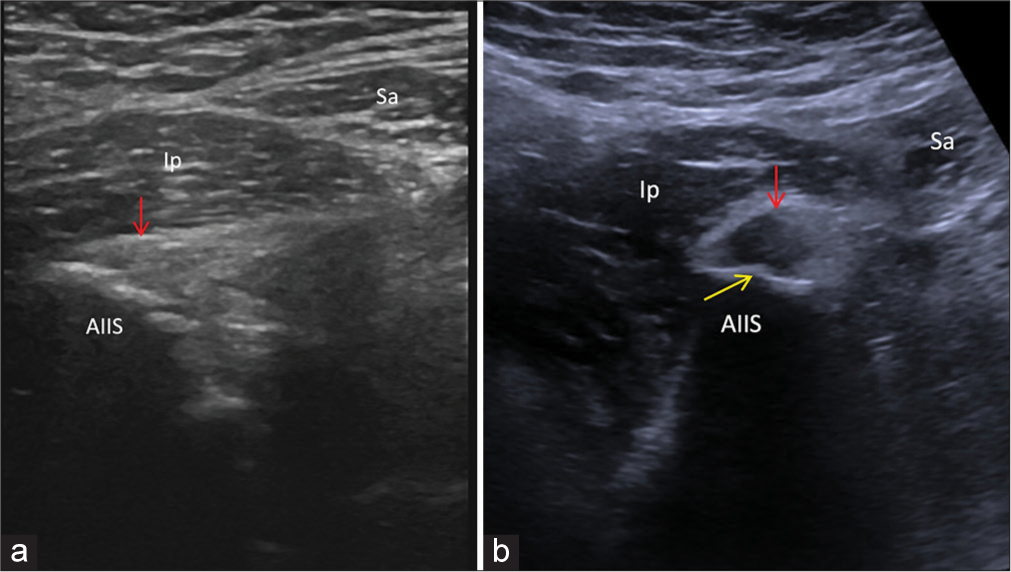 RF straight (direct) head tendinopathy. (a) Short axis ultrasound image demonstrates mild heterogeneous echotexture (red arrow) of the RF origin with irregularity (yellow arrows) of the AIIS enthesis. (b) Short axis ultrasound image in a different patient showing more marked tendinopathy (red arrow) with a prominent enthesophyte at the AIIS (yellow arrow). RF: Rectus femoris, AIIS: Anterior inferior iliac spine, Ip: Iliopsoas, Sa: Sartorius.