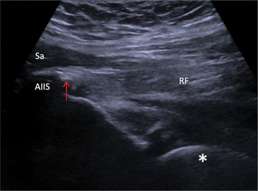 RF straight (direct) calcific tendinopathy. Long axis ultrasound image demonstrates a prominent calcification (red arrow) and heterogenous echotexture of the RF straight head origin. AIIS: Anterior inferior iliac spine, RF: Rectus femoris, Sa: Sartorius, Asterisk: Femoral head arthroplasty.