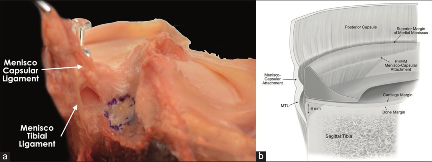 (a) Sagittal view of a cadaveric dissection of the posterior horn medial meniscus (PHMM) anatomy, showcasing the meniscocapsular and meniscotibial ligament (MTL) attachments as they merge to form a common attachment. The posterior cruciate ligament facet is outlined in methylene blue to illustrate the proximity of its tibial attachment. (b) Illustration of the PHMM and shared common attachment of the meniscocapsular ligament and MTL. The MTL attached 5.9 mm distal to the articular cartilage margin of the posterior medial tibial plateau. Figure used with permission from DePhillipo et al.[17]