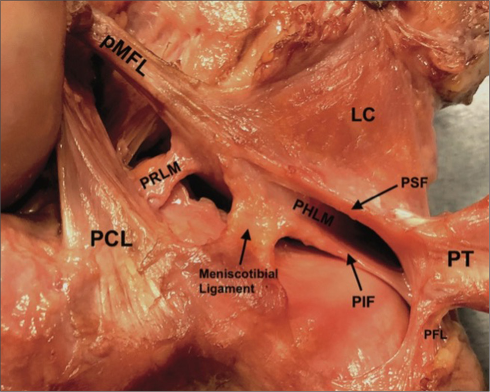 Posteromedial view photograph of the anatomic attachments to the posterolateral meniscus in a right knee. LC: Lateral capsule, PCL: Posterior cruciate ligament, PFL: Popliteofibular ligament, PHLM: Posterior horn of the lateral meniscus, PIF: Posteroinferior popliteomeniscal fascicle, pMFL: Posterior meniscofemoral ligament, PRLM: Posterior root of the lateral meniscus, PSF: Posterosuperior popliteomeniscal fascicle, PT: Popliteal tendon. Figure used with permission from Aman et al.[12]