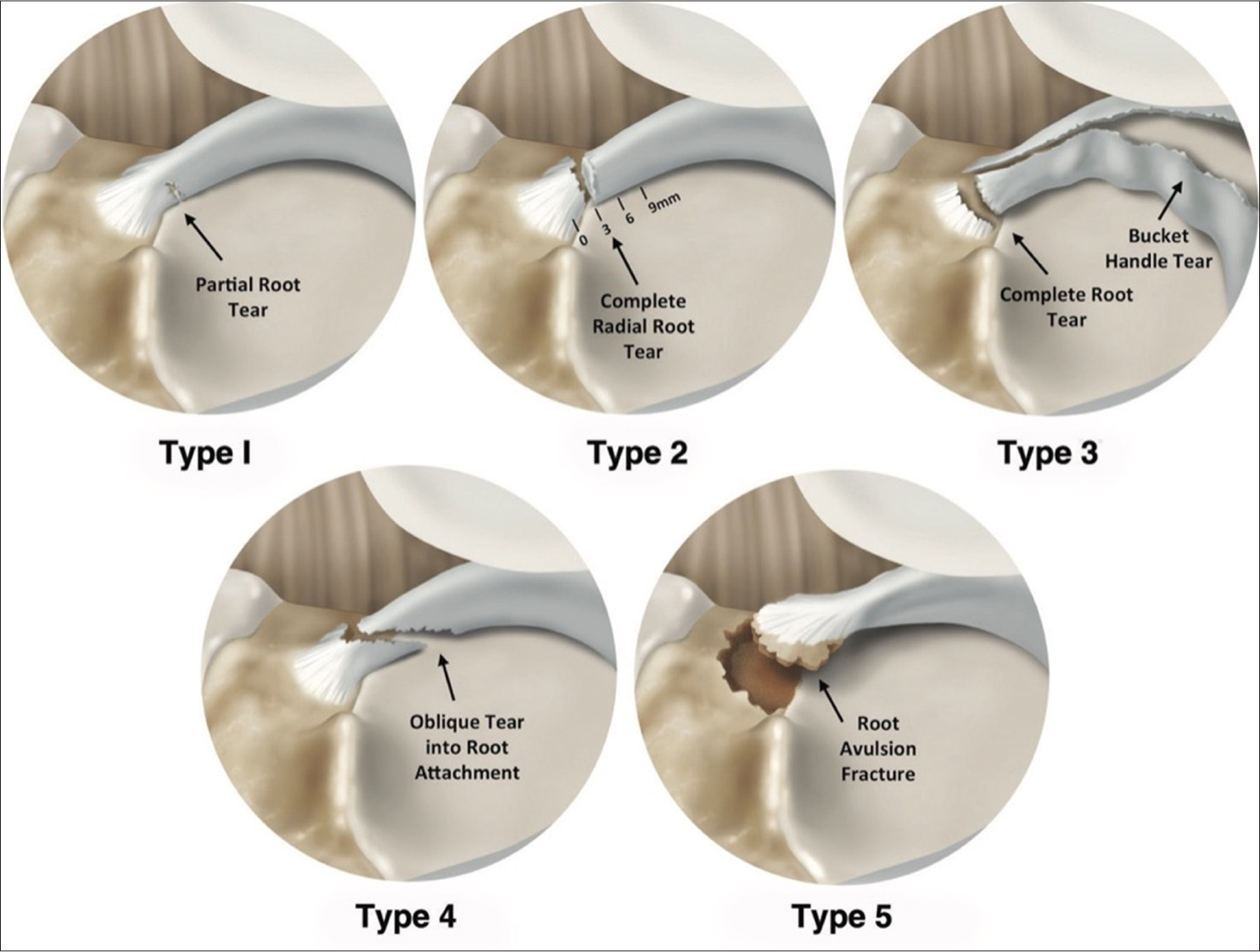 Illustrations of the meniscal root tear classification system in five different groups based on tear morphology. All meniscal tears are shown as medial meniscal posterior root tears for consistency in this illustration. The five tear patterns were classified based on morphology: (Type 1) partial stable root tear, (Type 2) complete radial tear within 9 mm from the bony root attachment, (Type 3) bucket-handle tear with complete root detachment, (Type 4) complex oblique or longitudinal tear with complete root detachment, and (Type 5) bony avulsion fracture of the root attachment. Figure used with permission from LaPrade et al.[20]